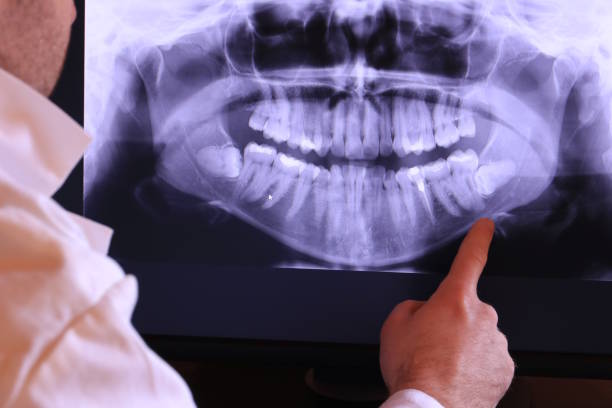 Best Emergency Wisdom Teeth Removal in Middletown, KY