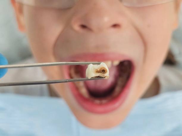Best Emergency Broken Tooth Repair in Middletown, KY